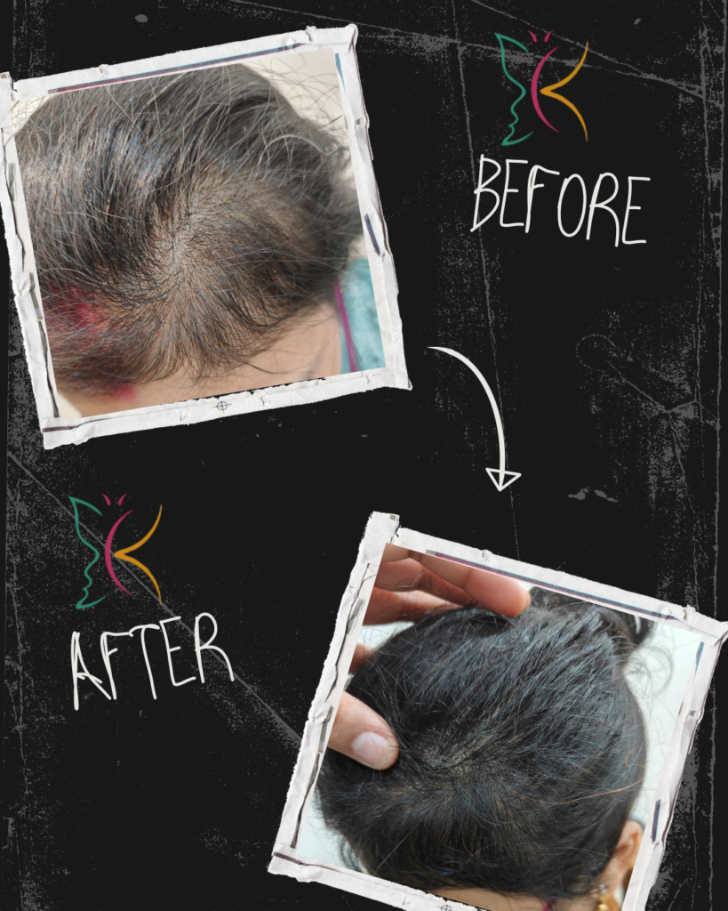 Hair loss treatment near me showing before and after improvement in scalp hair density