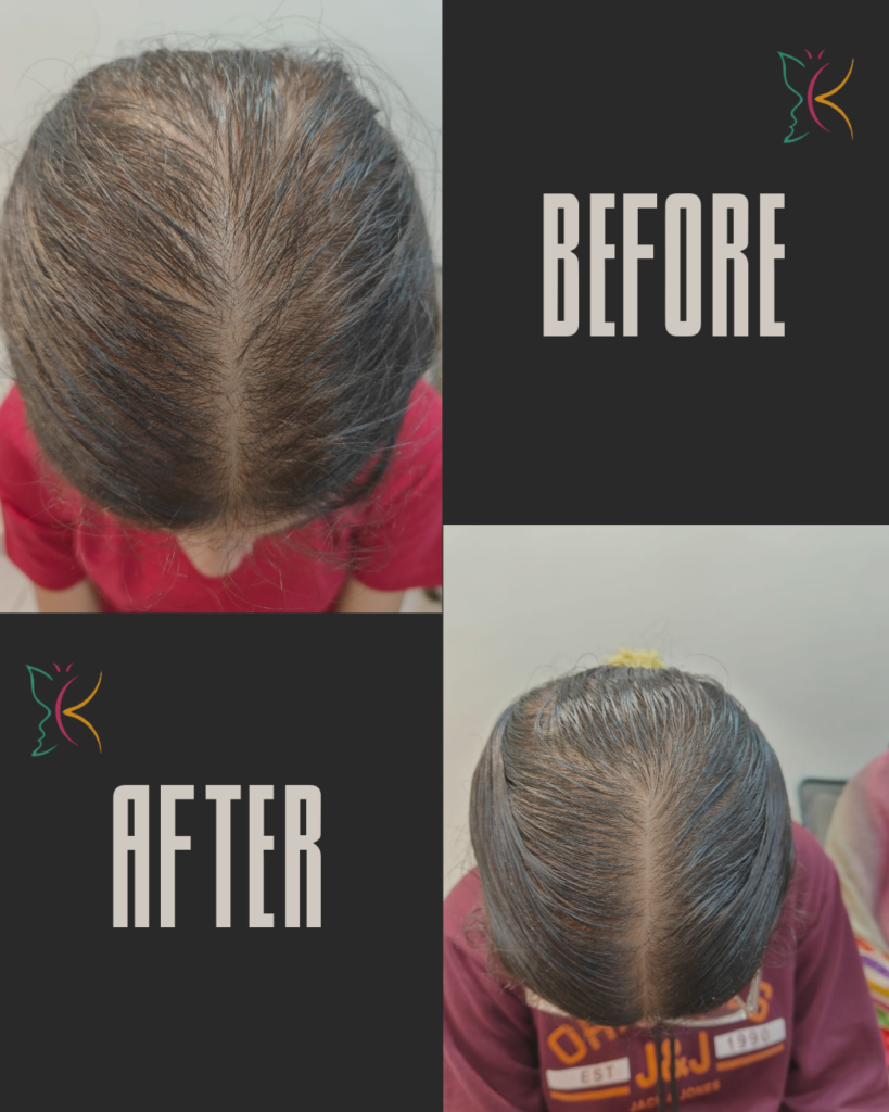 Hair loss treatment near me showing before and after improvement in hair density