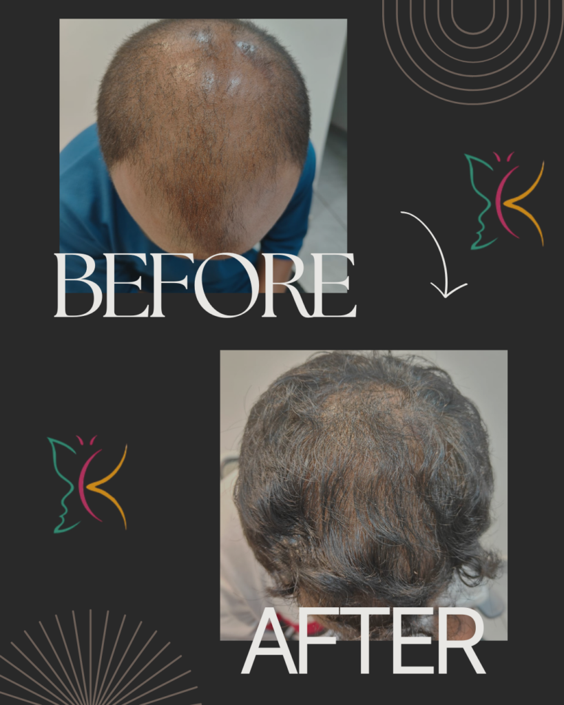 Hair loss treatment near me showing before and after improvement in scalp hair density