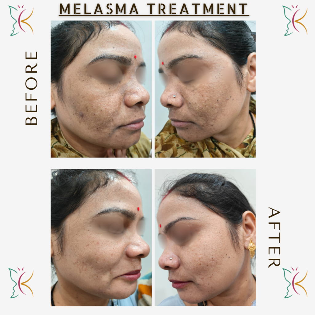 Melasma treatment showing before and after reduction in facial pigmentation