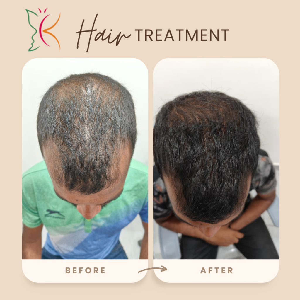 Hair loss treatment near me showing before and after hair regrowth results
