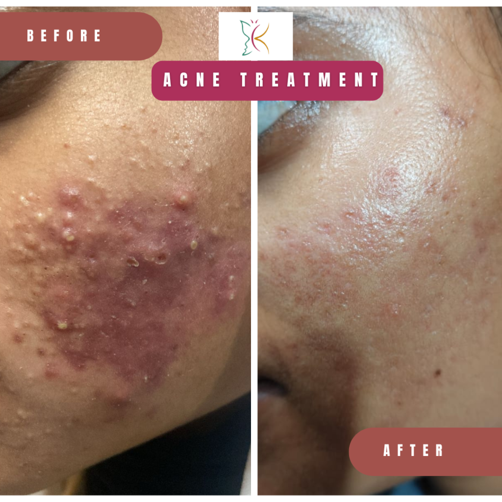 Acne treatment showing before and after reduction in pimples and skin redness