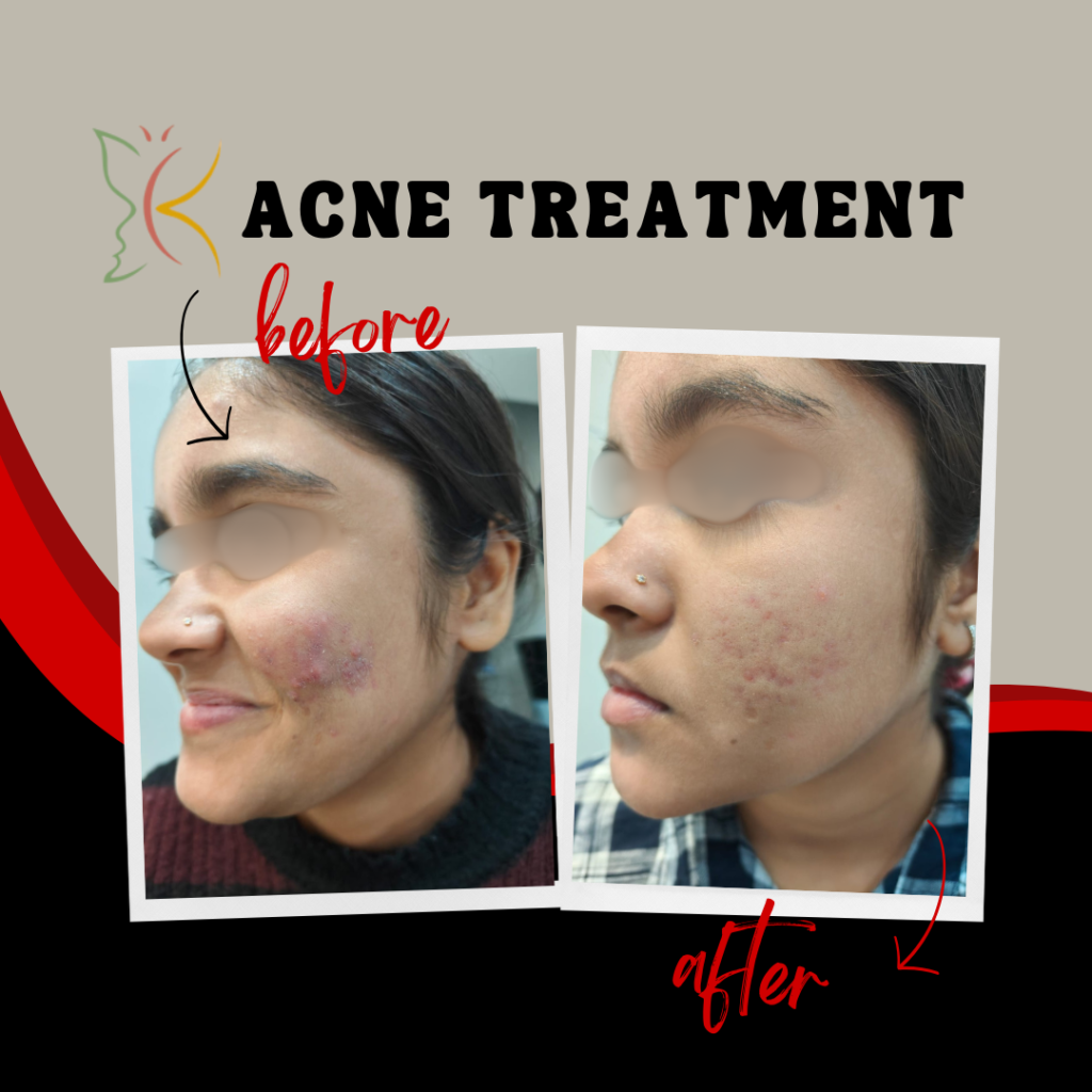Acne treatment showing before and after reduction in pimples and acne marks