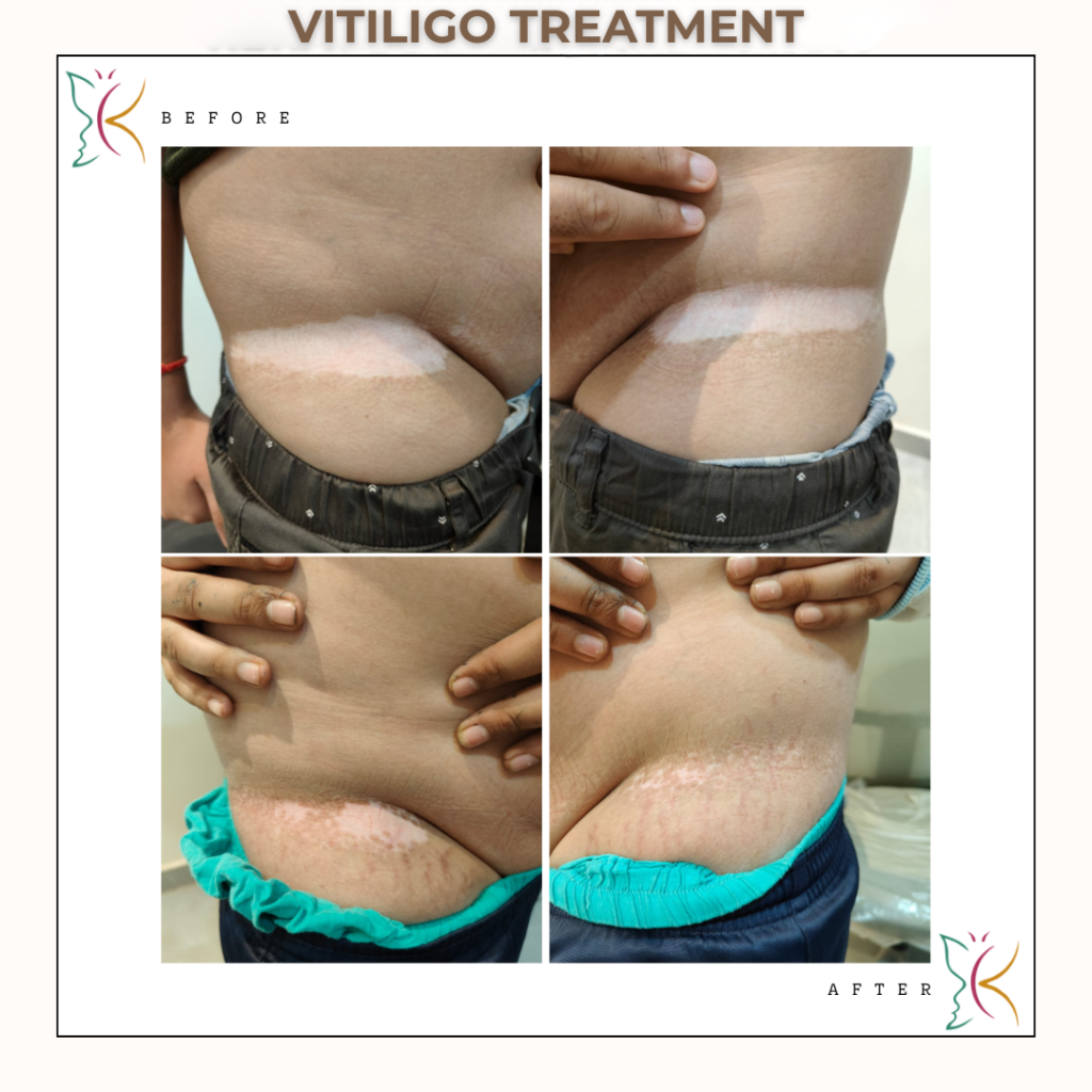 Before and after vitiligo treatment showing skin repigmentation by expert dermatologist at Kayakalp Skin Clinic near me